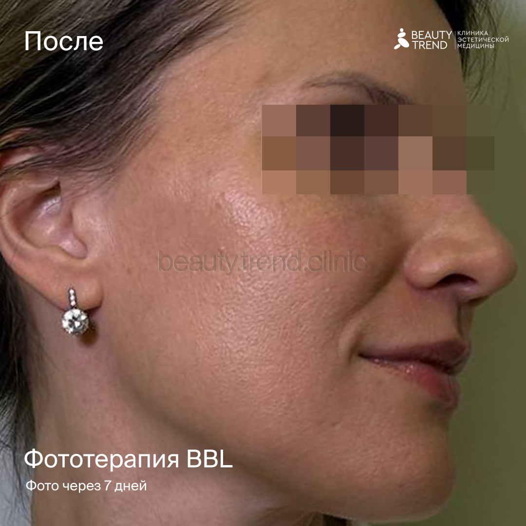 Фототерапия BBL - после 1